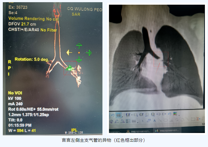 1704678007328342.png 气管异物.png
