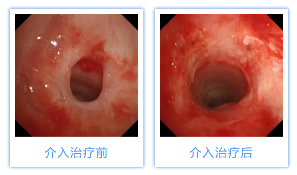 介入.png